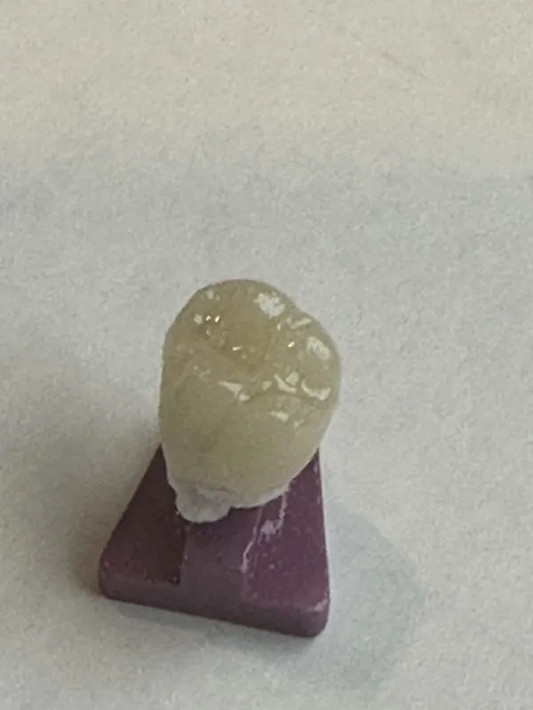 A custom porcelain restoration color-matched at The JM Dental in Orange County